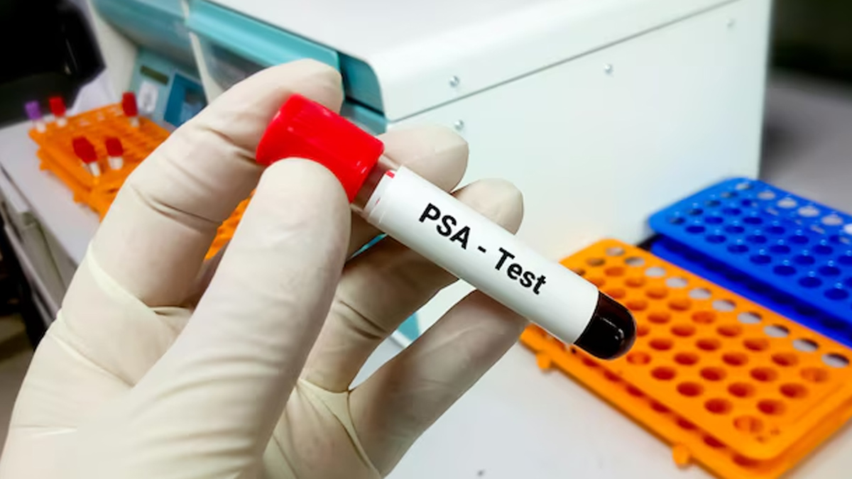 Prostate-Specific-Antigen