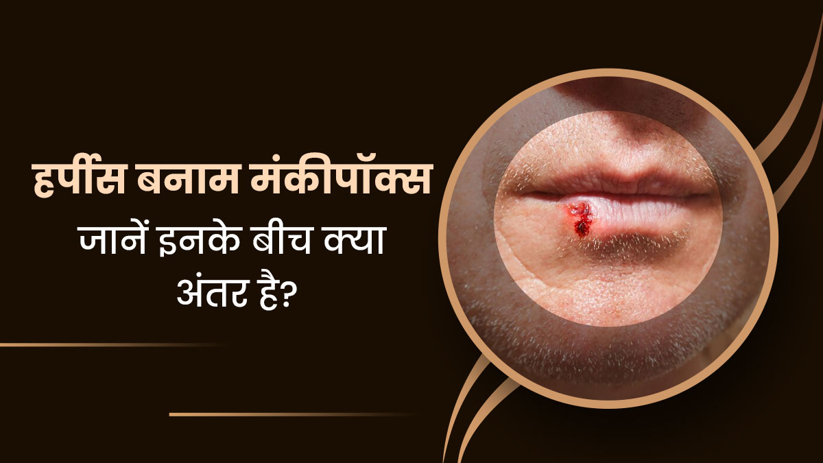 हर्पीस और मंकीपॉक्स के कारण त्वचा पर हो जाते हैं रैशेज, जानें इन दोनों में अंतर?