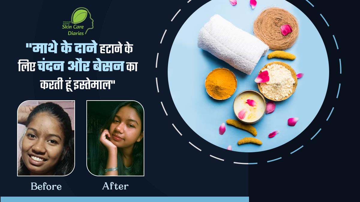 रोशनी भारद्वाज के माथे पर बार-बार हो जाते थे पिंपल्स, बेसन और चंदन पैक लगाने से दूर हुई समस्या 