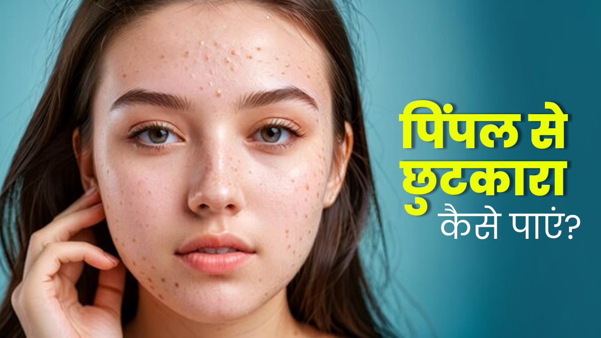 चेहरे पर बार-बार हो जाते हैं पिंपल्स? राहत पाने के लिए अपनाएं ये 5 उपाय