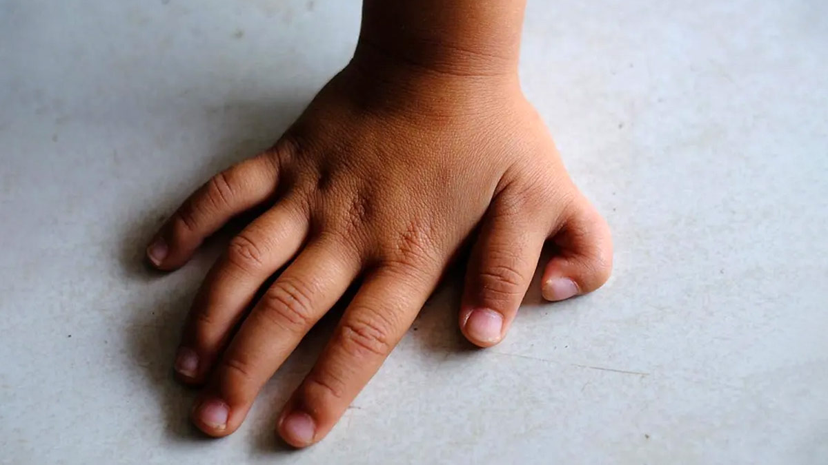 क्या बच्चों में 6 उंगलियां होना किसी समस्या का संकेत होता है? डॉक्टर से जानें 