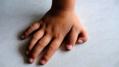 क्या बच्चों में 6 उंगलियां होना किसी समस्या का संकेत होता है? डॉक्टर से जानें 