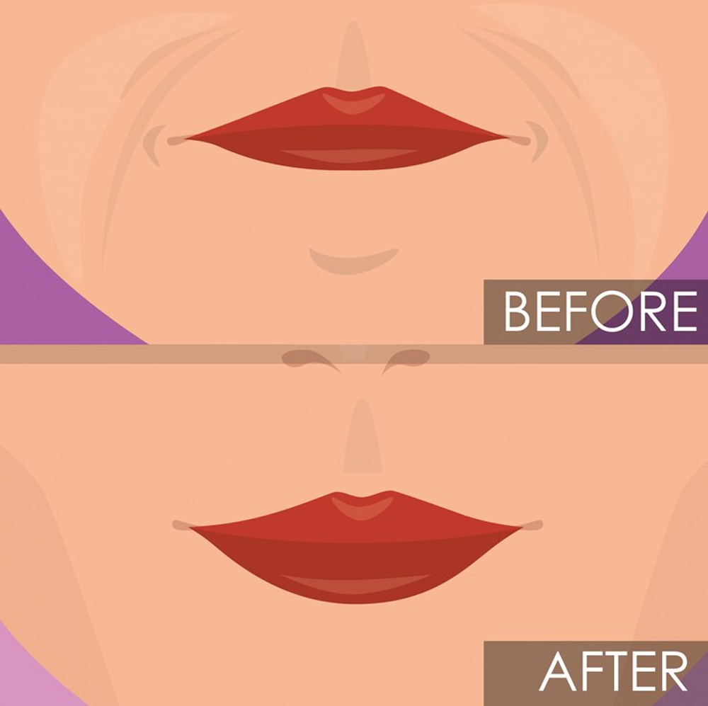 lip-lift