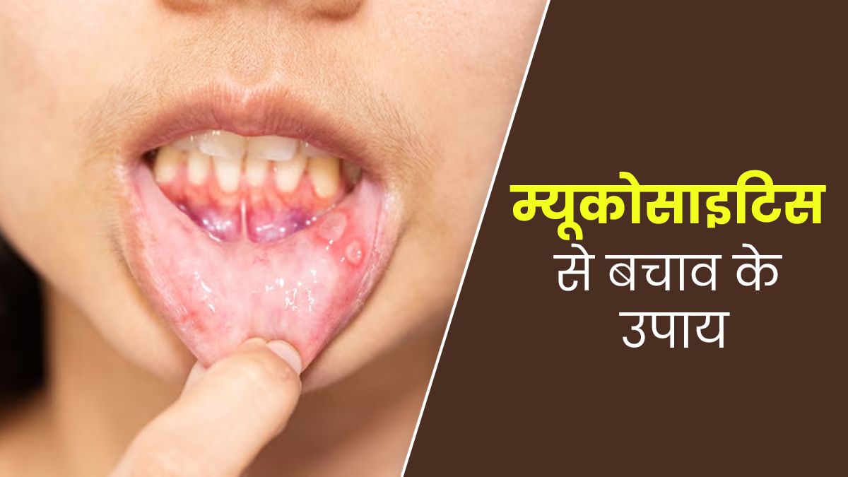 म्यूकोसाइटिस (मुंह के छाले) से बचाव के लिए अपनाएं ये 5 उपाय, एक्सपर्ट से जानें