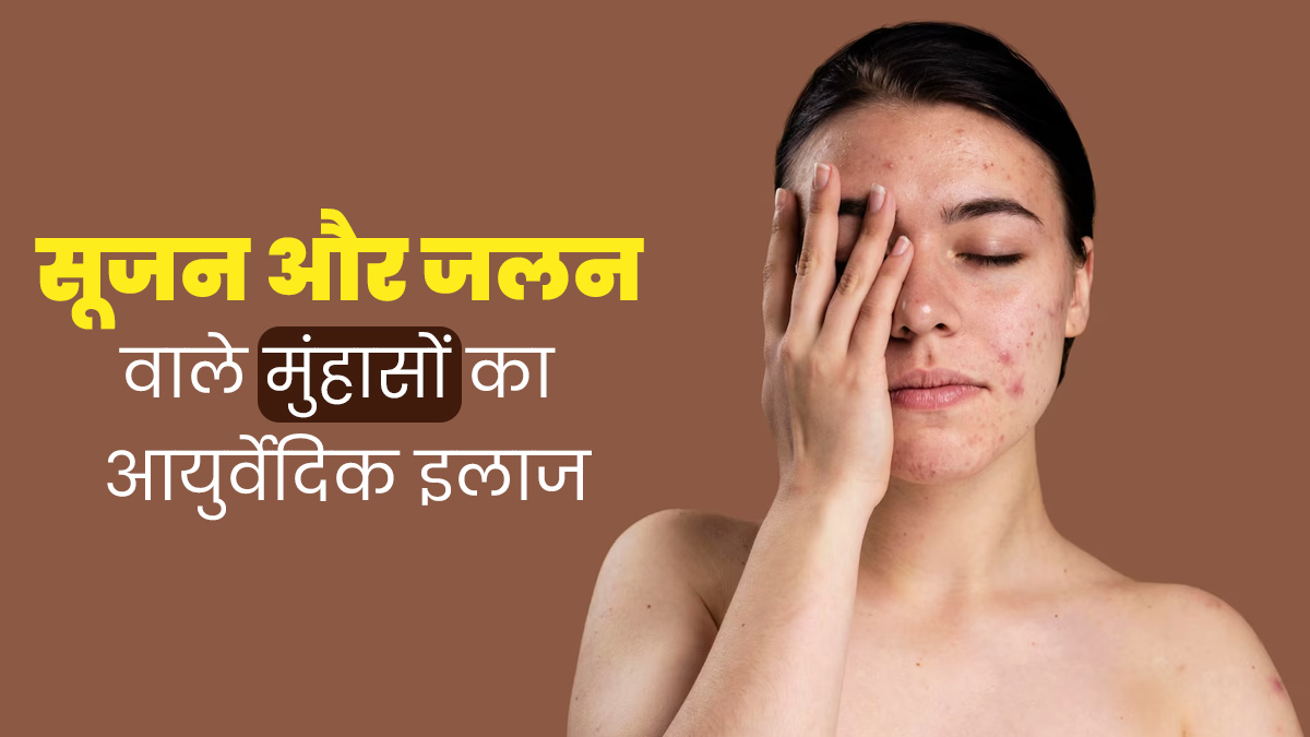 सूजन और जलन वाले मुंहासों को दूर करने के लिए अपनाएं ये आयुर्वेदिक इलाज, तुरंत मिलेगी राहत 