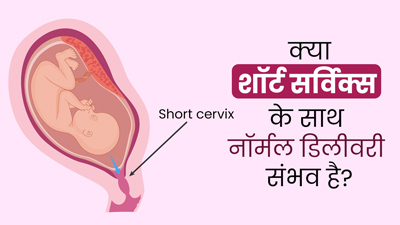 Short Cervix: क्या बच्चेदानी का मुंह छोटा होने पर नॉर्मल डिलीवरी संभव है? डॉक्‍टर से जानें 