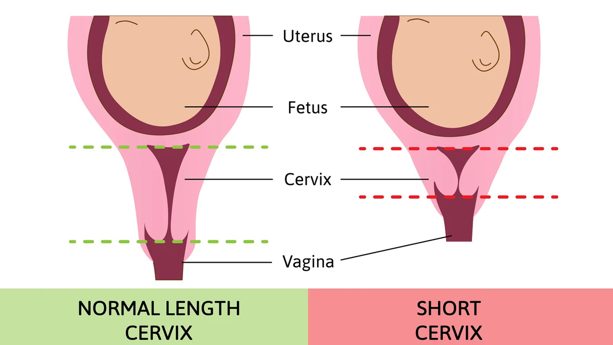 is normal delivery possible with short cervix