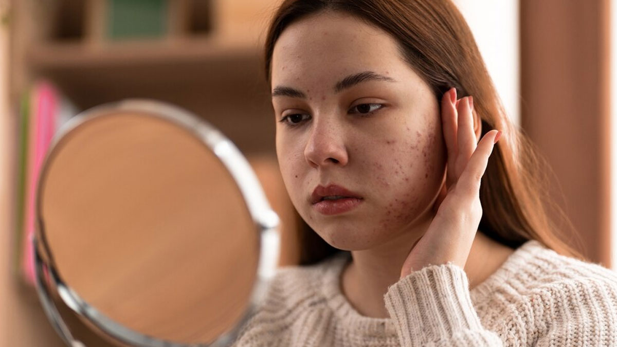 Say Goodbye To Acne: 7 Everyday Habits That Might Be Causing Your Breakouts