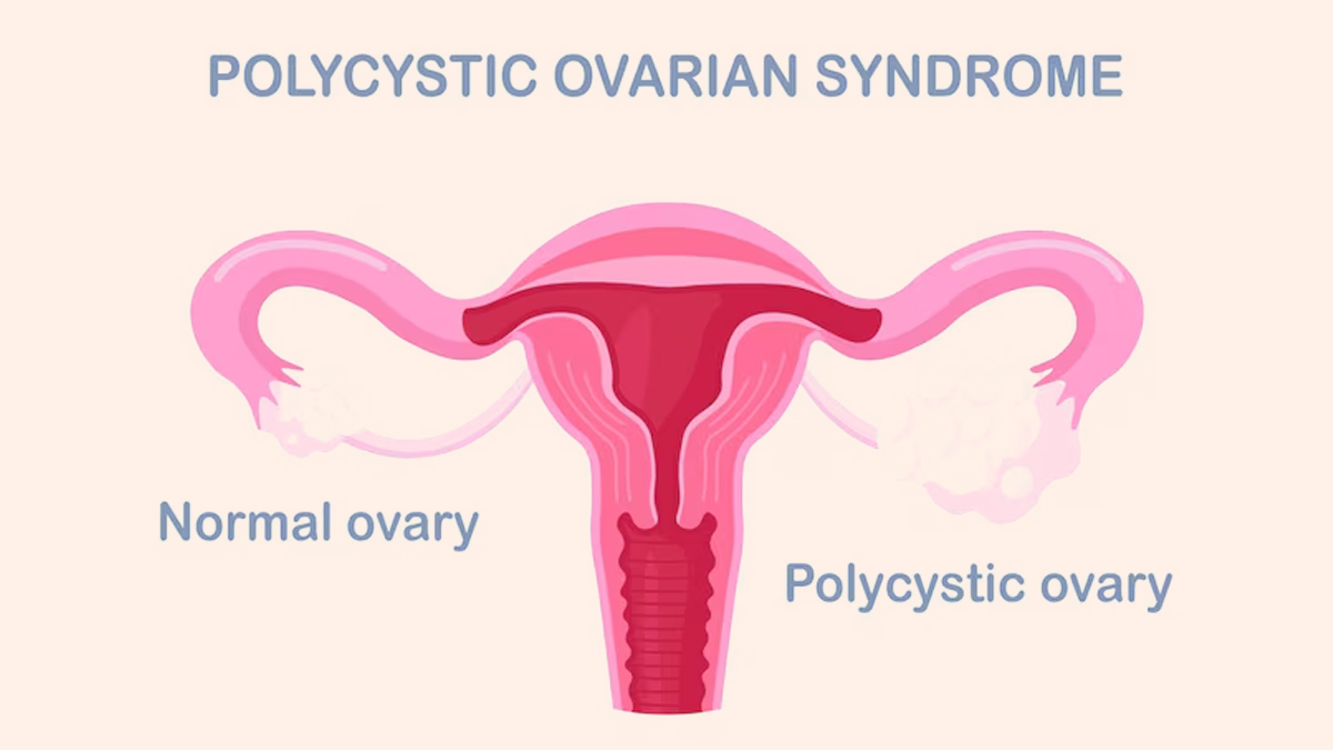 PCOS