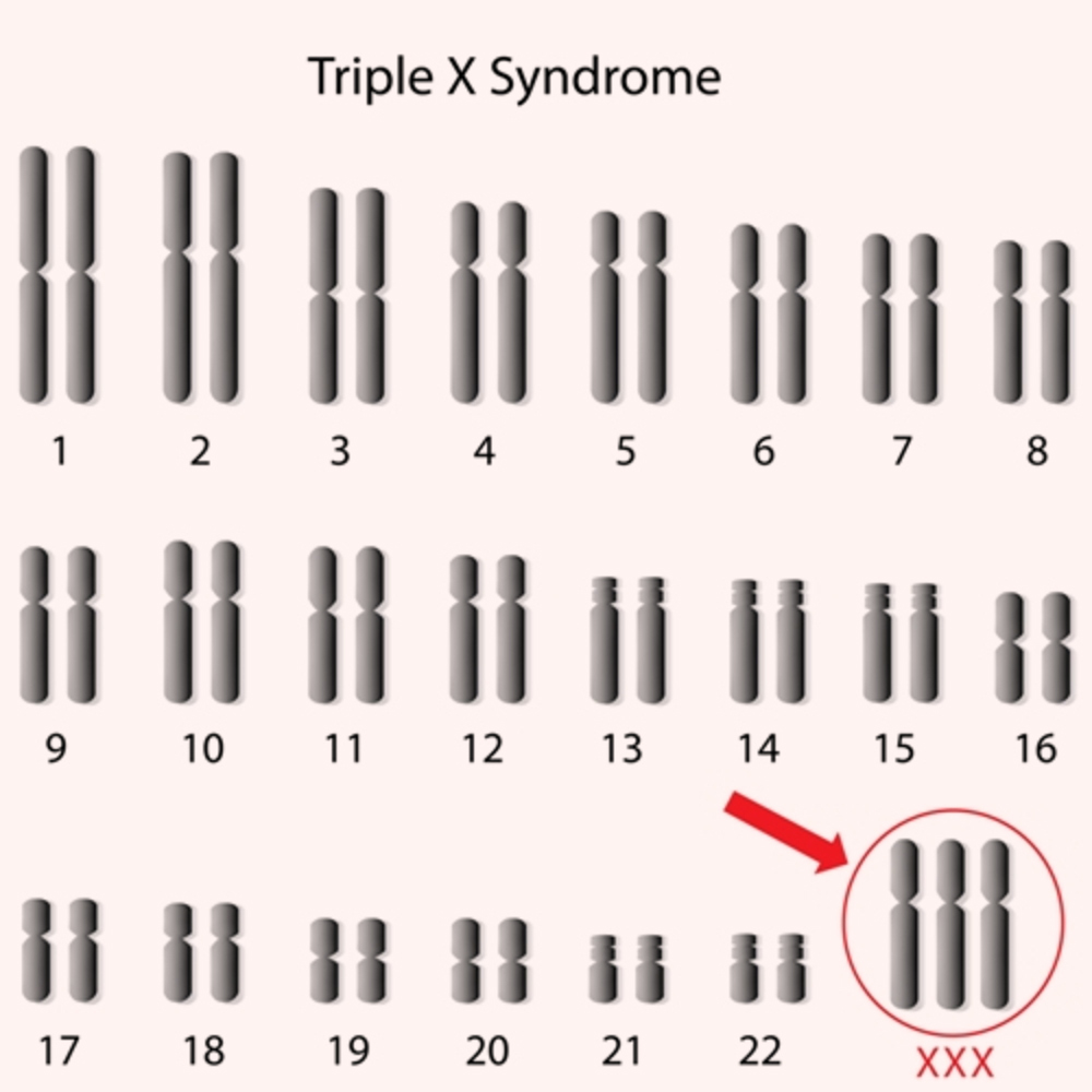 Triple-X-Syndrome