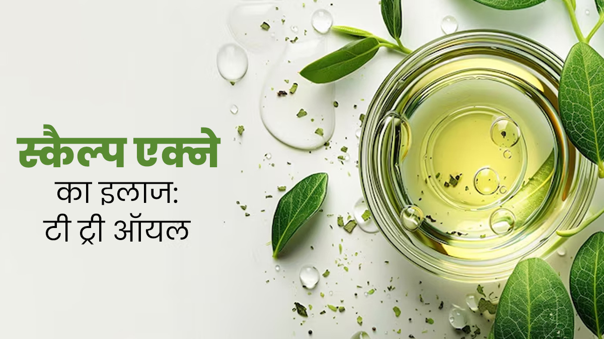 Scalp Acne: सिर पर हो गए हैं दाने? छुटकारा पाने के लिए टी ट्री ऑयल का इस तरह करें इस्तेमाल 