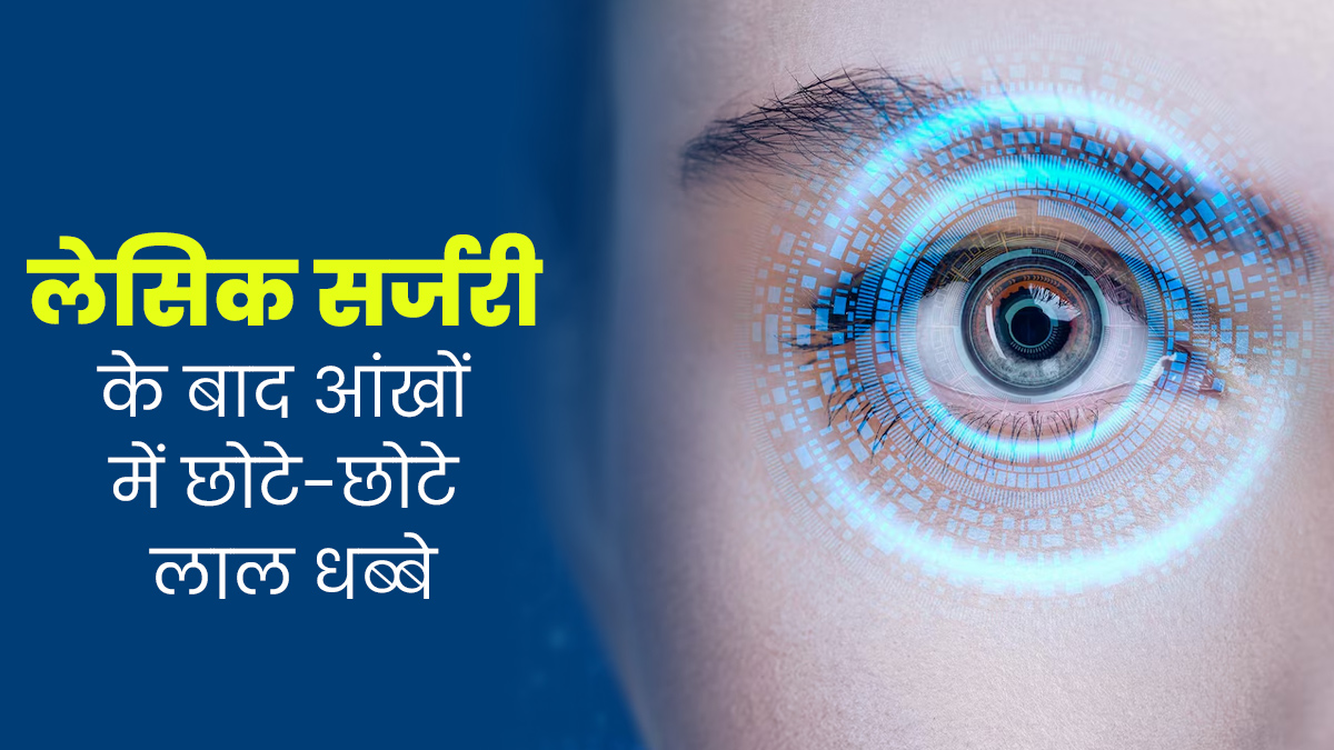 क्या लेसिक सर्जरी के बाद आंखों में छोटे-छोटे लाल धब्बे आना सामान्य है? जानें एक्सपर्ट की राय