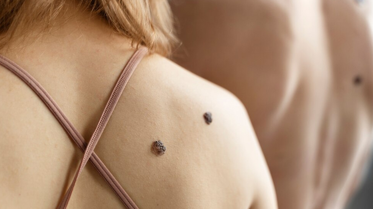 skin-tags