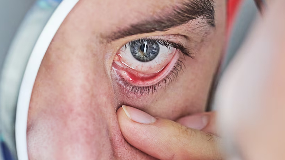 2-corneal-blindness-causes