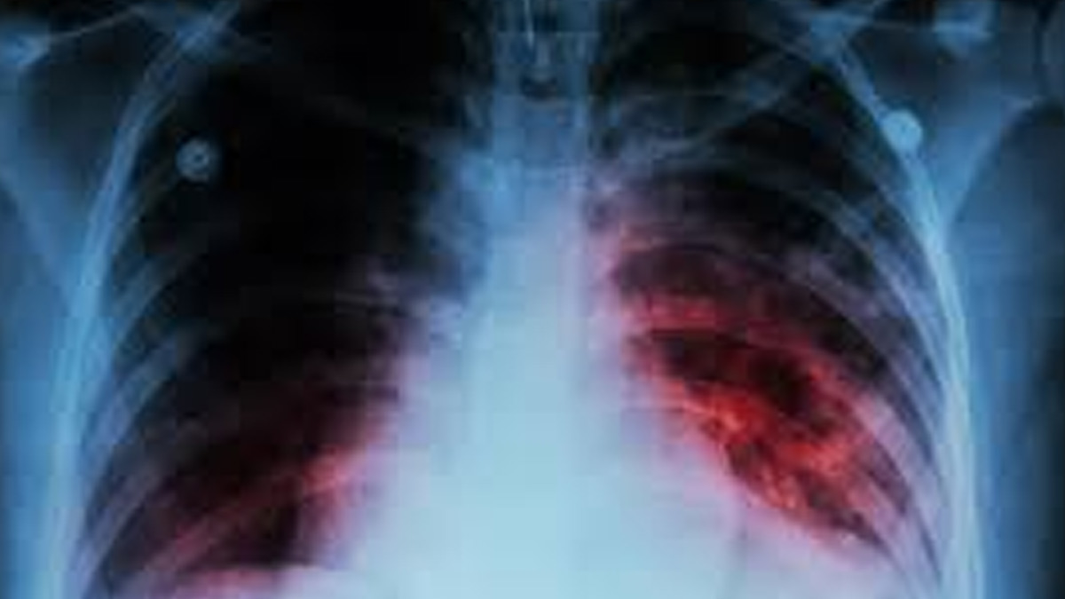 WHO Report Highlights India's High TB Treatment Coverage And Surge In Preventive Therapy Efforts