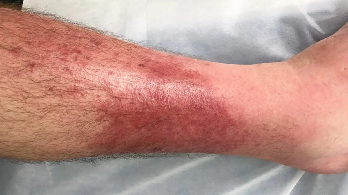 Why That Minor Skin Redness Might Be a Major Health Concern? Expert Lists Complications Of Cellulitis