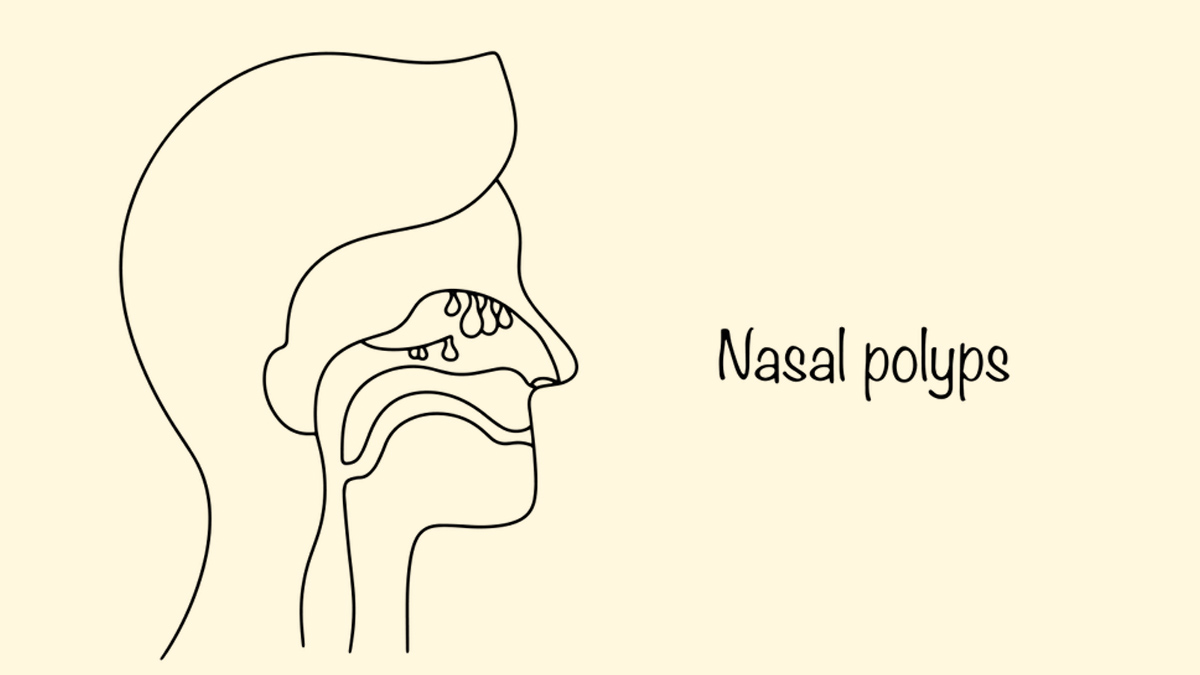 From Allergies to Asthma, These Conditions Can Trigger Nasal Polyps