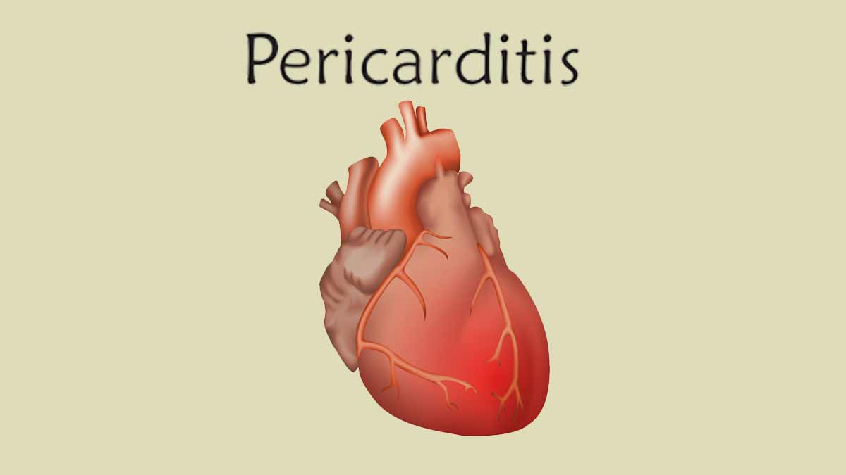 pericarditis