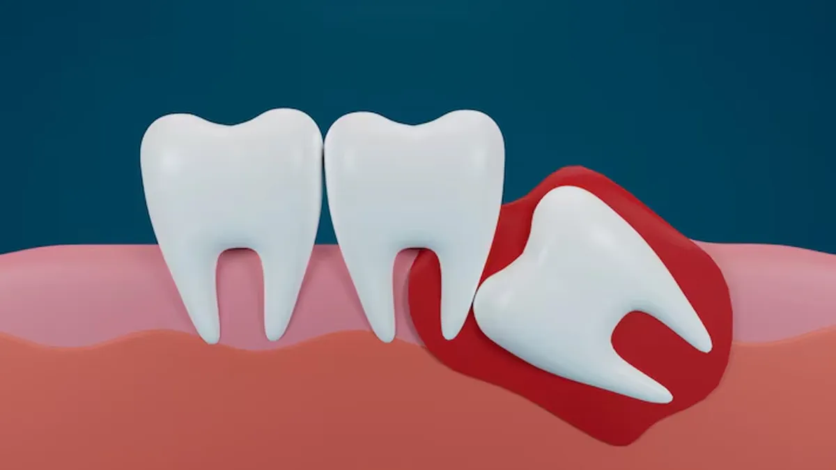 Can Sideways-Growing Wisdom Teeth Straighten Themselves? Here’s What You Need to Know