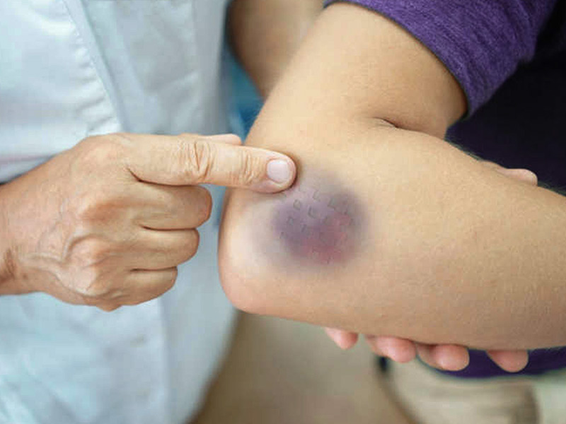 Do You Frequently Bump Into Things And Bruise? Here's What You Should Add  In Your Diet | OnlyMyHealth