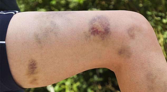 bruises-causes-inside1