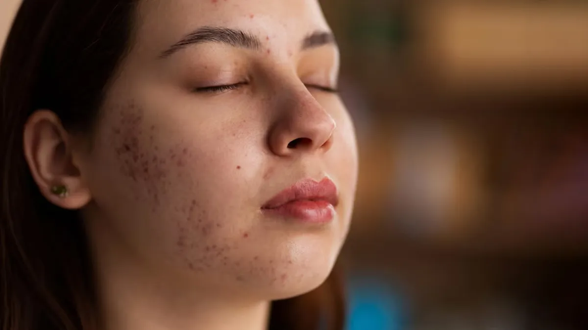 Home Remedies: How To Remove Dark Spots Caused By Pimples