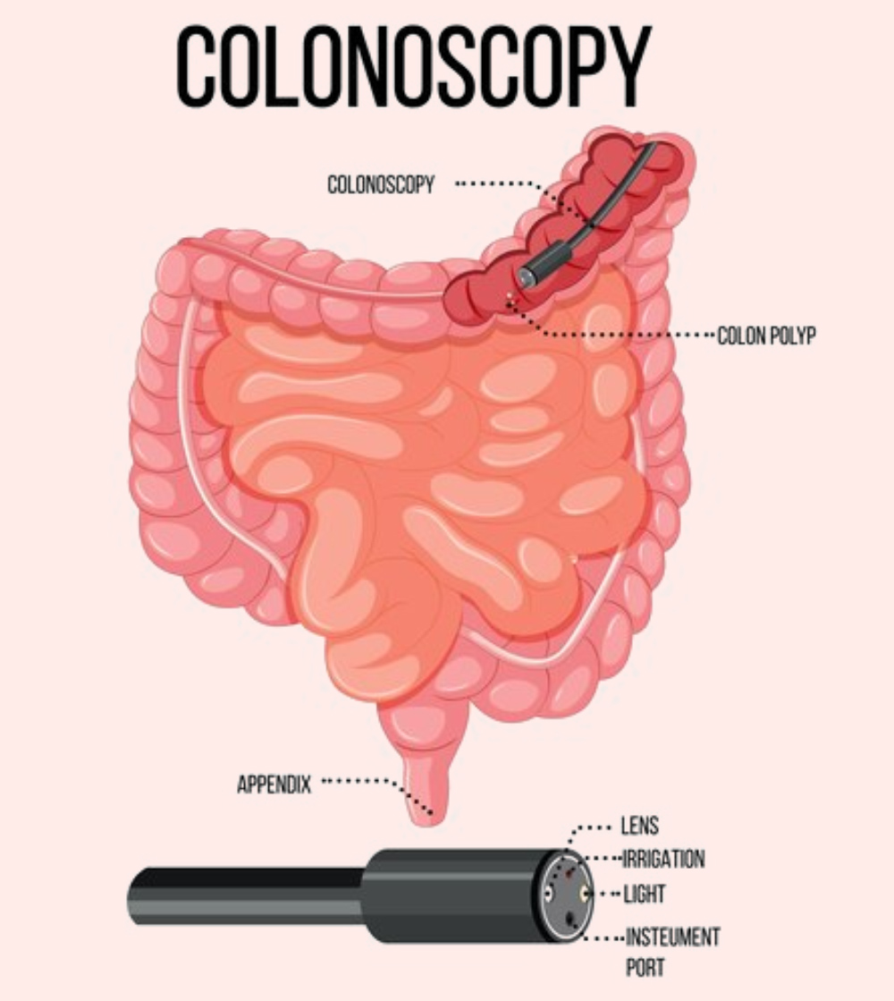 colonoscopy