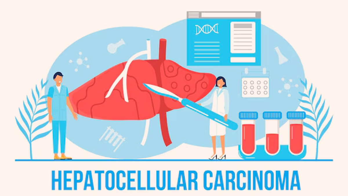 hepatocellular-carcinoma