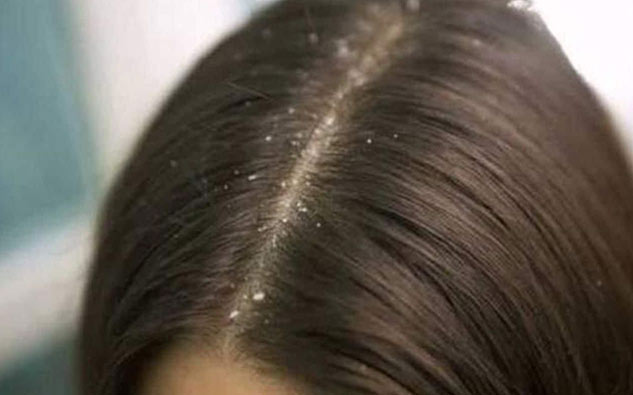 inside2_DandruffVsDryScalp