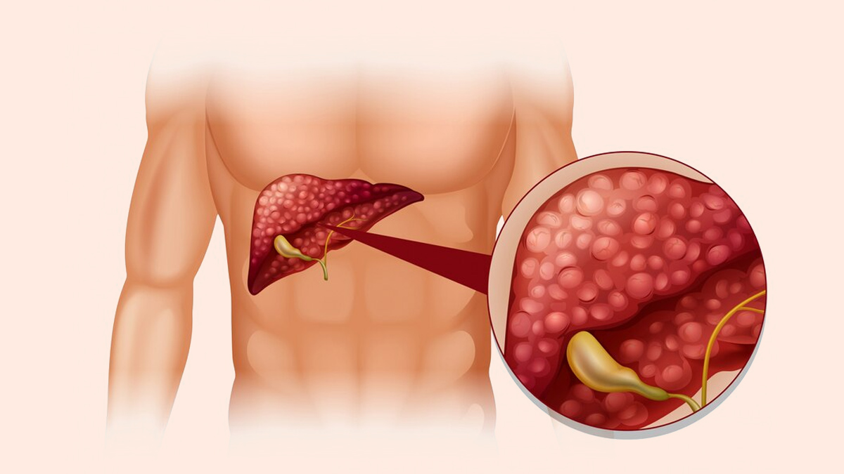 liver-cancer