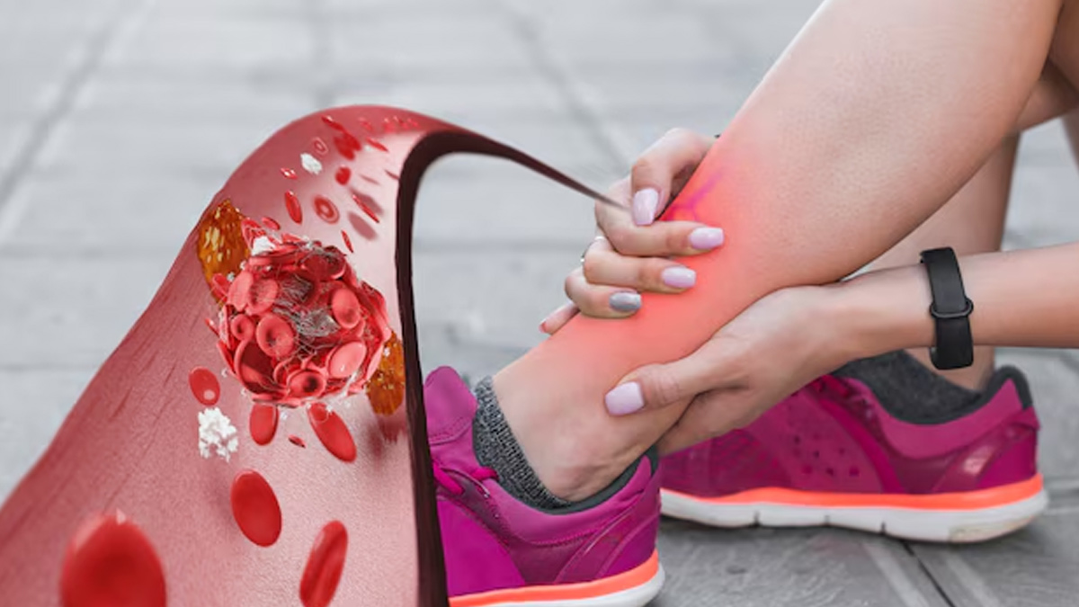 thrombiosis-symptoms