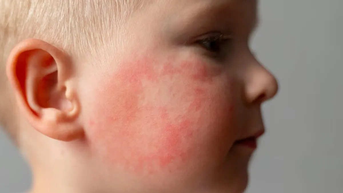 Bright Red Rash On Cheeks Could Be Slapped Cheek Disease: Here's What It Is, Cause, Symptoms, Risk Factors, And Treatment Options
