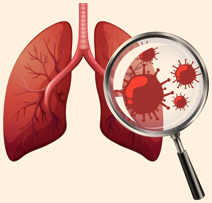 pneumonia