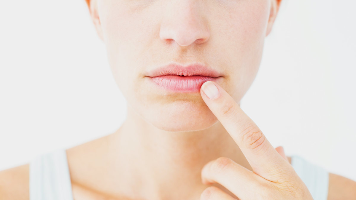 Cracked-Lips-Corners-2