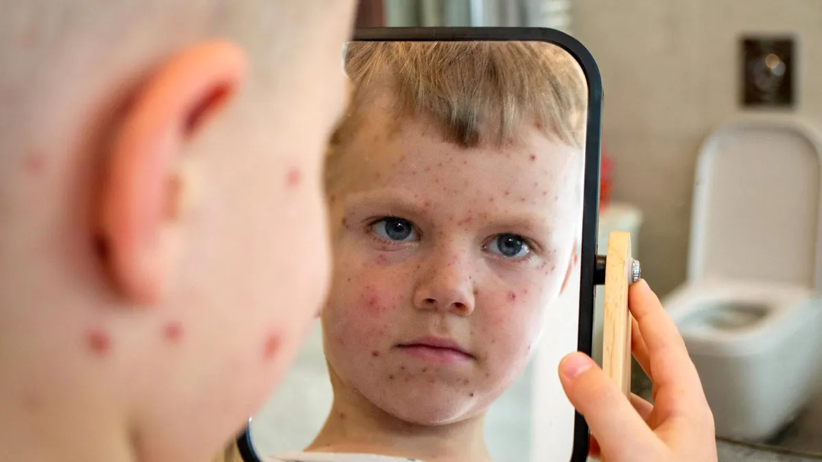 Global Measles Surge: WHO Alerts On Risks For Children Under 5—Expert Tips To Stay Protected