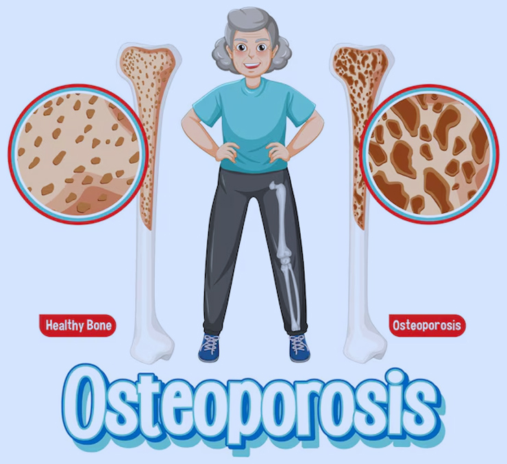 osteoporosis