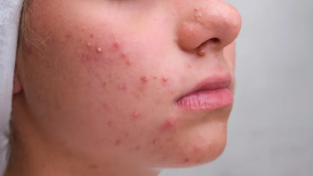 Are Your Hair Products to Blame for Breakouts? 7 Telltale Signs to Watch For