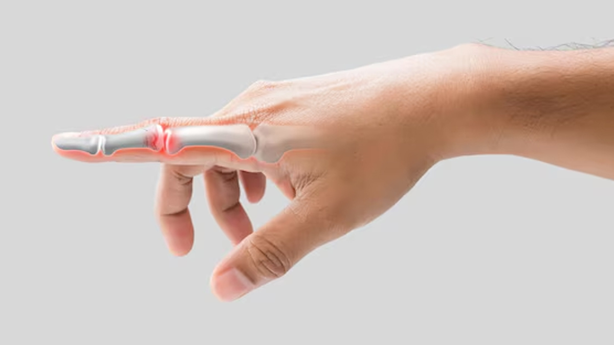 stenosing-tenosynovitis