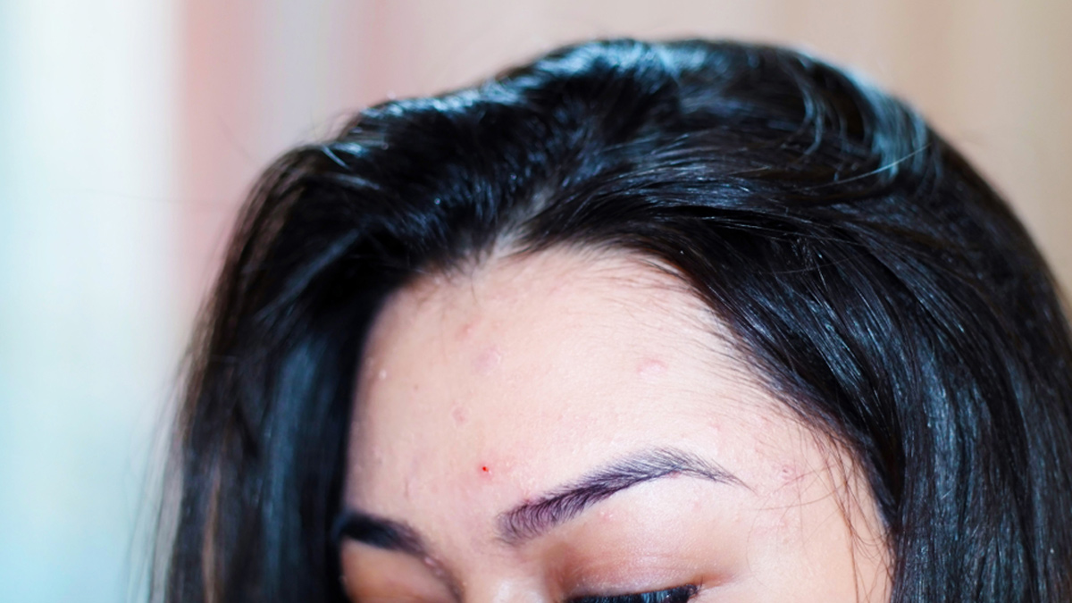 forehead-acne