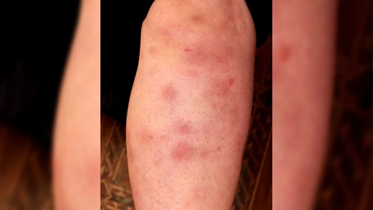 Panniculitis Is Common In Winter: Here Are Some Remedies That Can Help