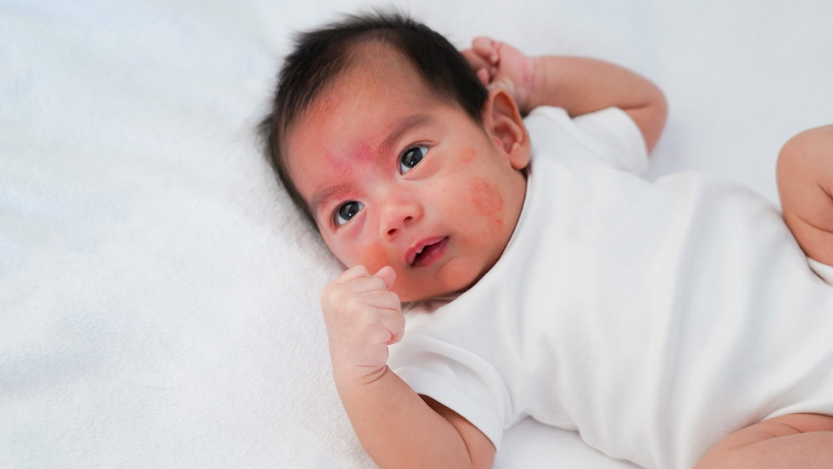 Baby Skincare: Home Remedies For Managing Eczema In Cold Weather