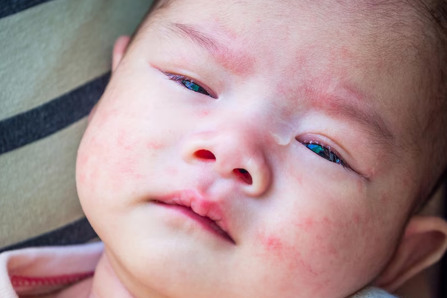 baby-eczema