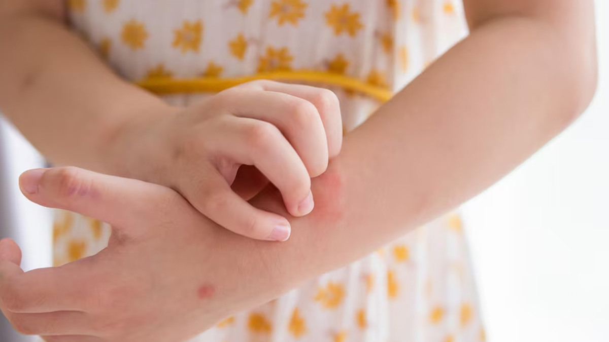 From Cold Compress to Clothing: Here Are Home Remedies For Urticaria You Should Try