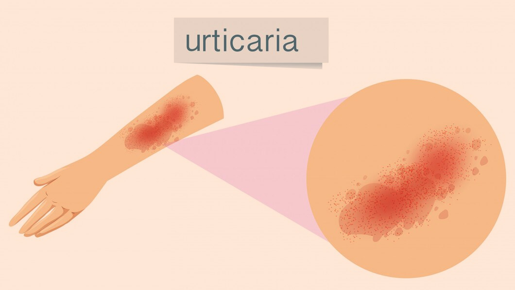 urticaria