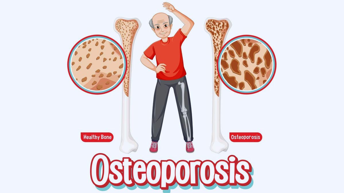 How Do Osteoporosis Risk Factors Differ For Men And Women? Doctor Explains Ways To Prevent It | OnlyMyHealth