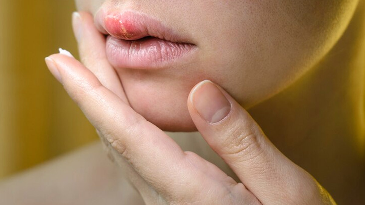 Avoid Kissing With Cold Sores: Expert Sheds Light On Its Association ...