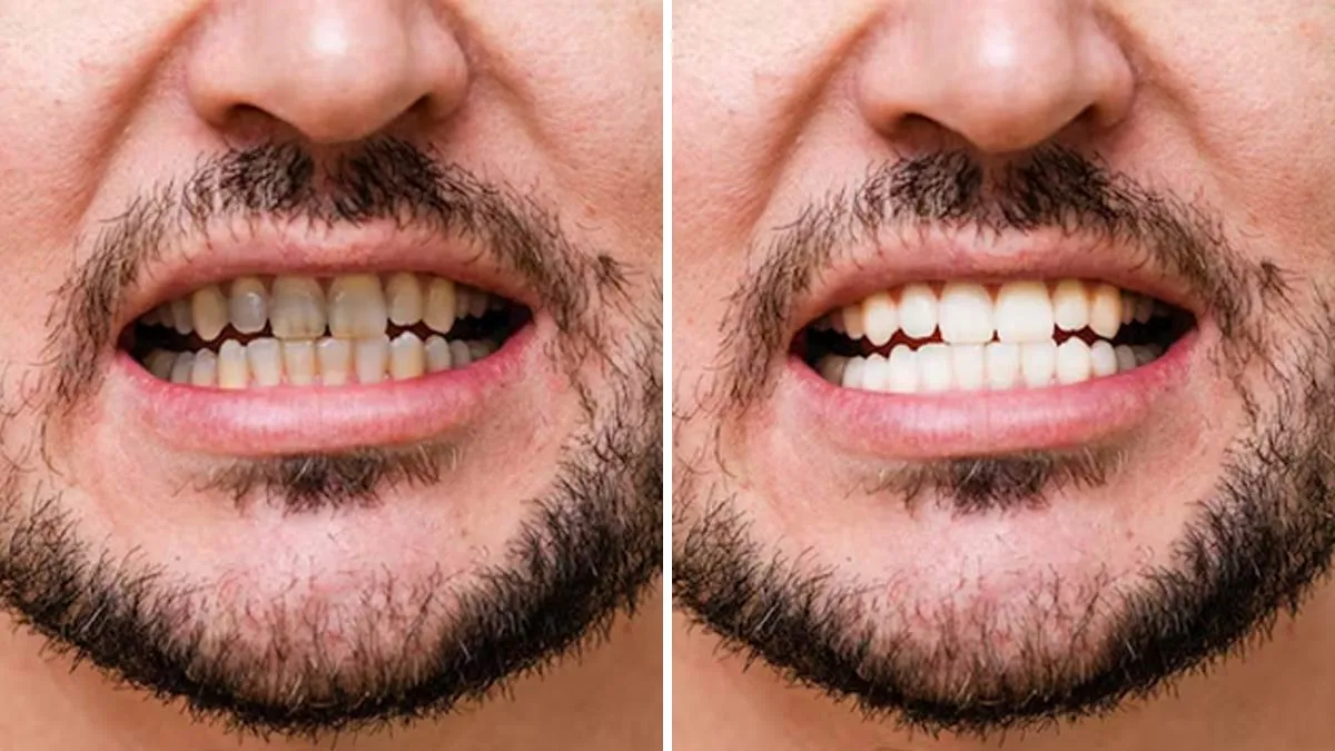 Is Your Lifestyle Causing Discoloured Teeth? Here’s What To Watch Out For