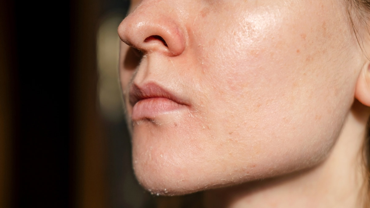 Dry Vs Dehydrated Skin: How To Find Your Skin Condition?