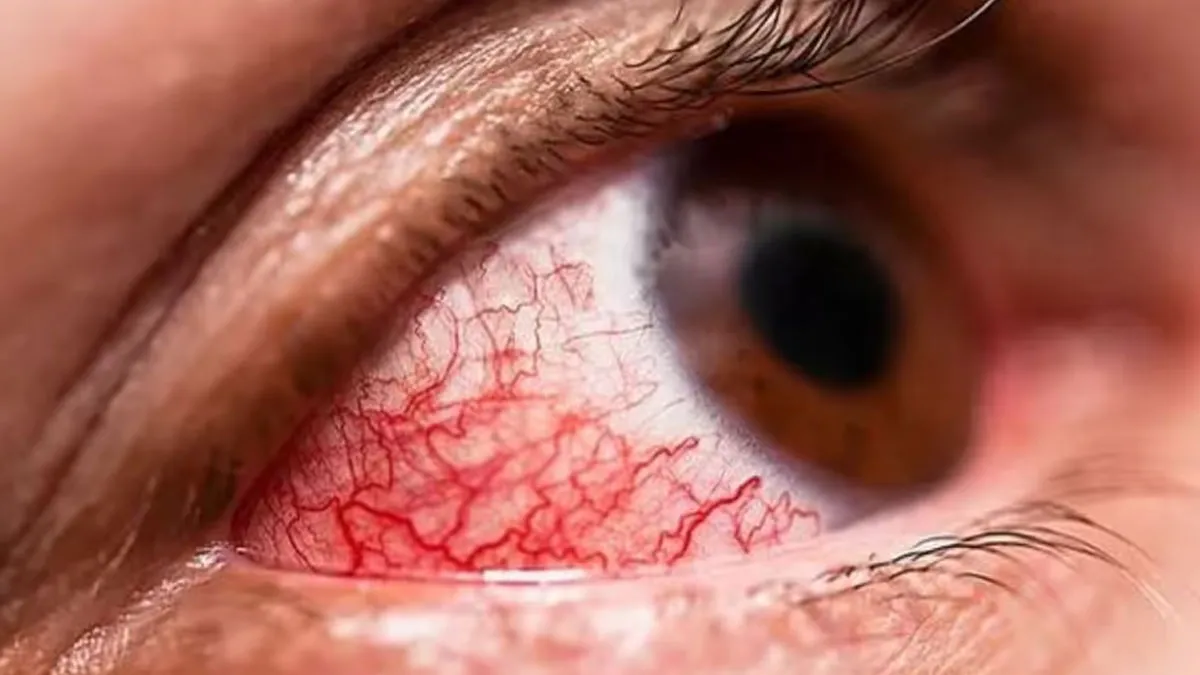'Bleeding Eye' Virus Claims 15 Lives In Rwanda: Know All About The Disease