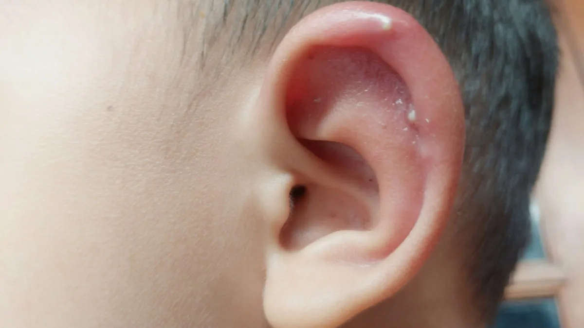 Soothe And Heal Boils In And Around The Ear With These Natural Remedies
